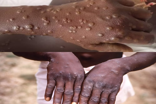 Mpox Facts: What you should know about this contagious disease